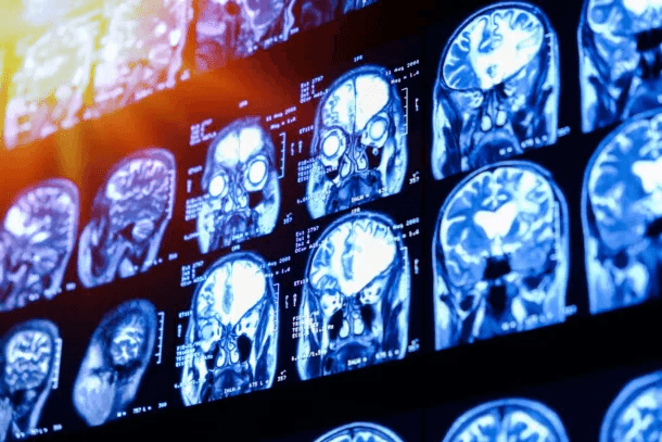 Image of multiple brain scans.